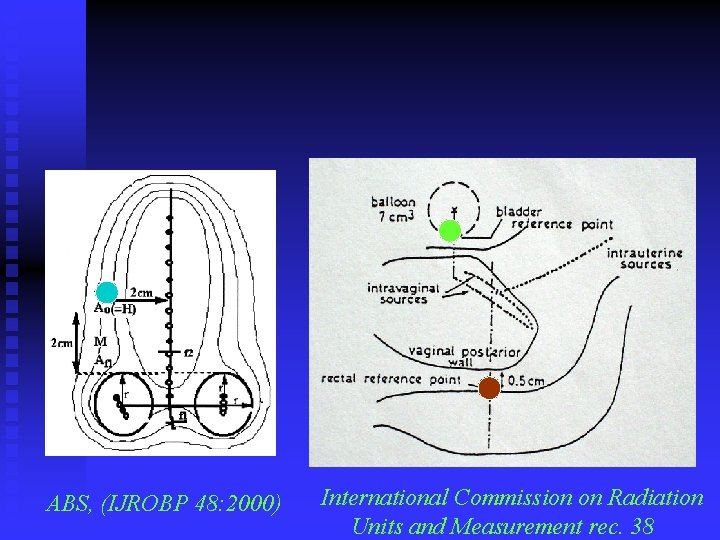 ABS, (IJROBP 48: 2000) International Commission on Radiation Units and Measurement rec. 38 