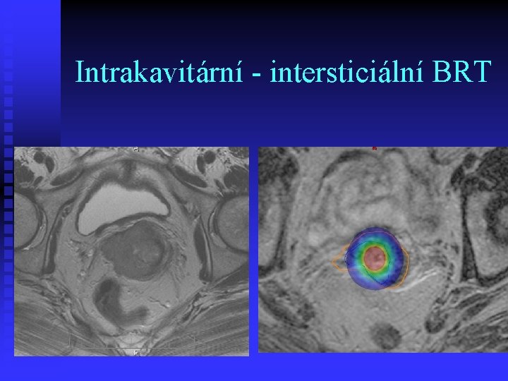 Intrakavitární - intersticiální BRT 