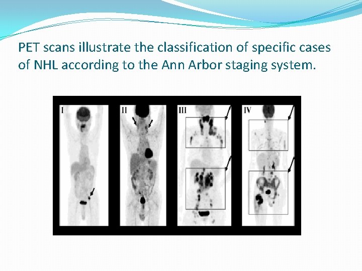 PET scans illustrate the classification of specific cases of NHL according to the Ann