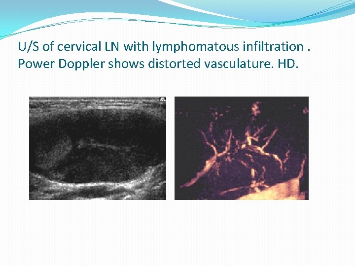 U/S of cervical LN with lymphomatous infiltration. Power Doppler shows distorted vasculature. HD. 