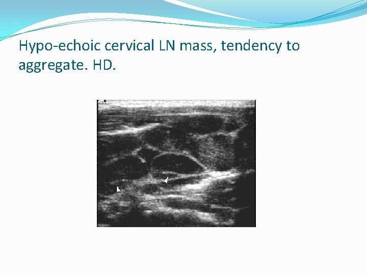 Hypo-echoic cervical LN mass, tendency to aggregate. HD. 