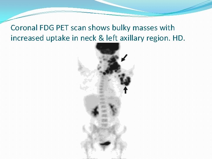 Coronal FDG PET scan shows bulky masses with increased uptake in neck & left