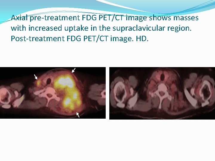 Axial pre-treatment FDG PET/CT image shows masses with increased uptake in the supraclavicular region.