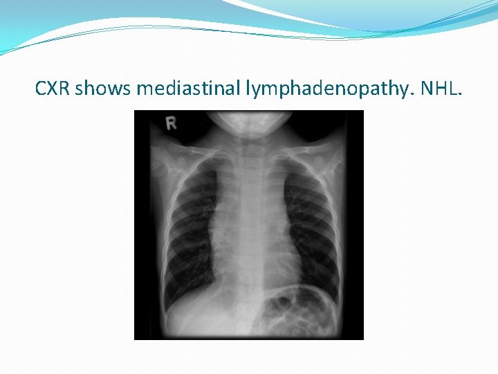 CXR shows mediastinal lymphadenopathy. NHL. 