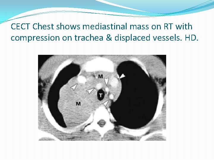 CECT Chest shows mediastinal mass on RT with compression on trachea & displaced vessels.
