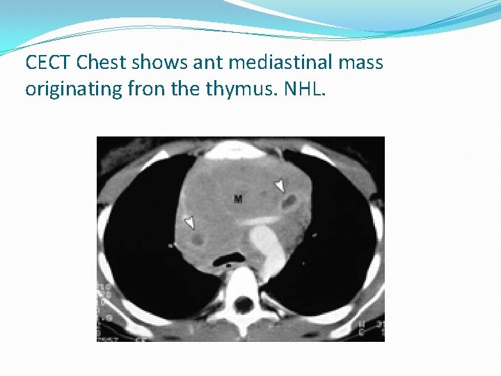 CECT Chest shows ant mediastinal mass originating fron the thymus. NHL. 