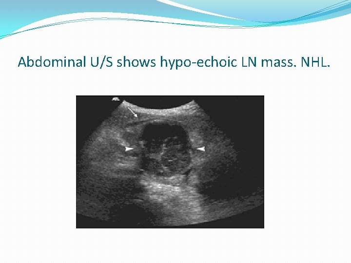 Abdominal U/S shows hypo-echoic LN mass. NHL. 