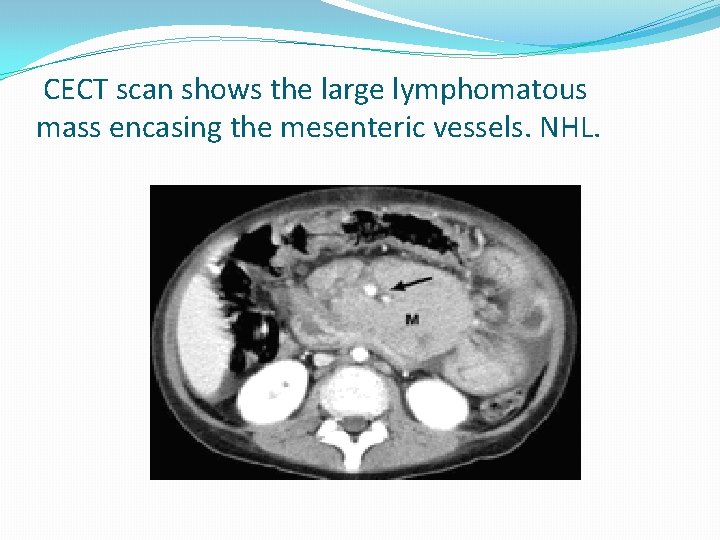  CECT scan shows the large lymphomatous mass encasing the mesenteric vessels. NHL. 