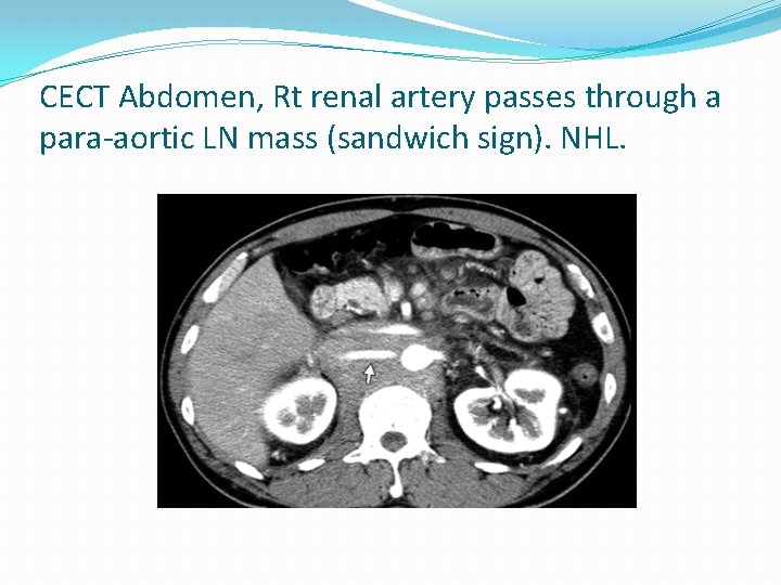CECT Abdomen, Rt renal artery passes through a para-aortic LN mass (sandwich sign). NHL.