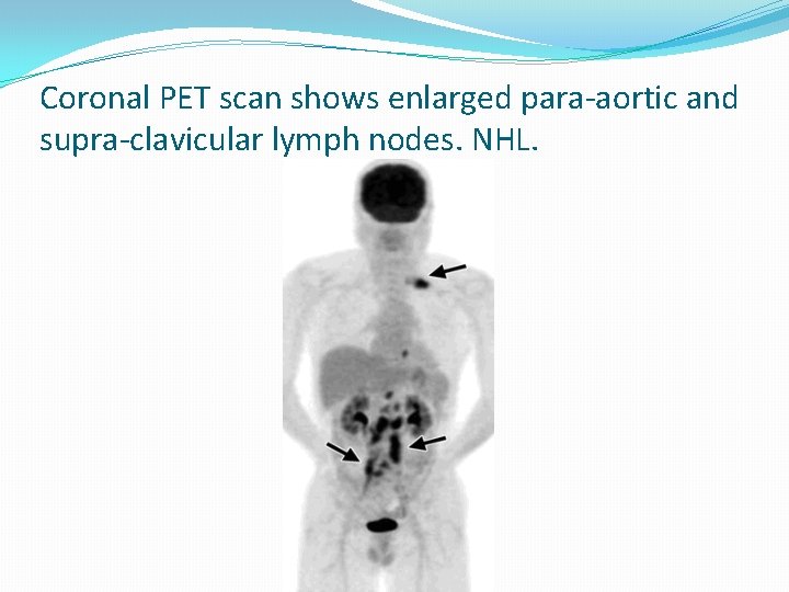 Coronal PET scan shows enlarged para-aortic and supra-clavicular lymph nodes. NHL. 