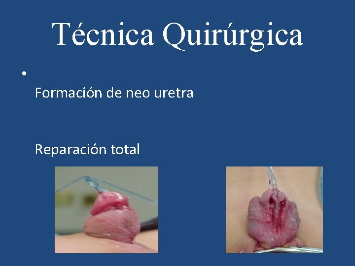 Técnica Quirúrgica • Formación de neo uretra Reparación total 