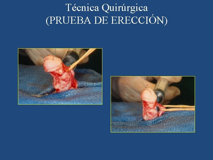 Técnica Quirúrgica (PRUEBA DE ERECCIÓN) 