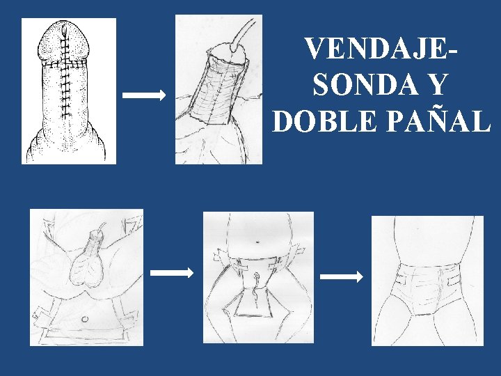 VENDAJESONDA Y DOBLE PAÑAL 