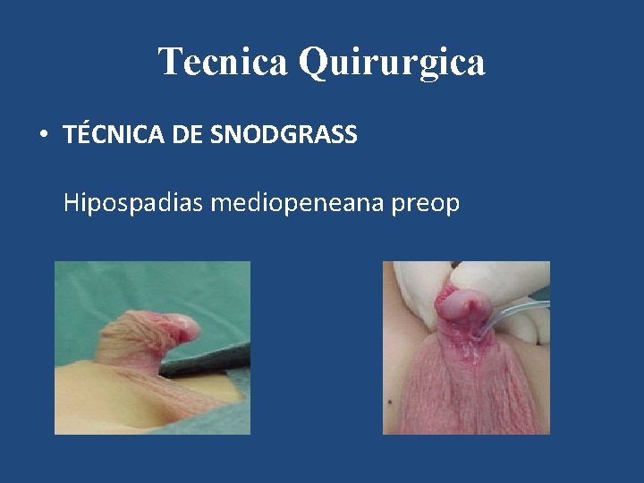 Tecnica Quirurgica • TÉCNICA DE SNODGRASS Hipospadias mediopeneana preop 