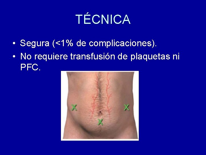 TÉCNICA • Segura (<1% de complicaciones). • No requiere transfusión de plaquetas ni PFC.