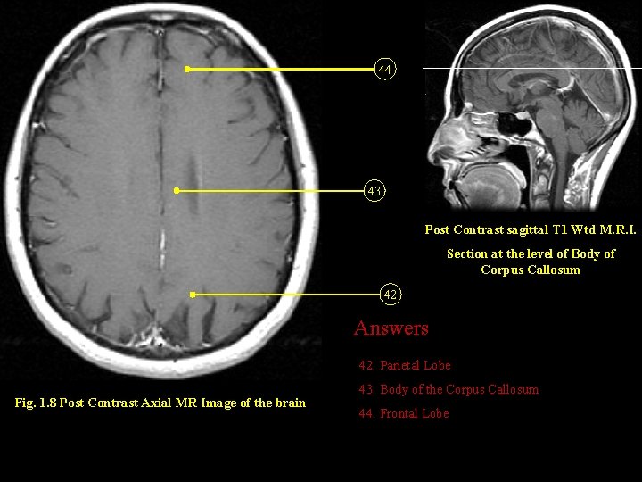 44 43 Post Contrast sagittal T 1 Wtd M. R. I. Section at the