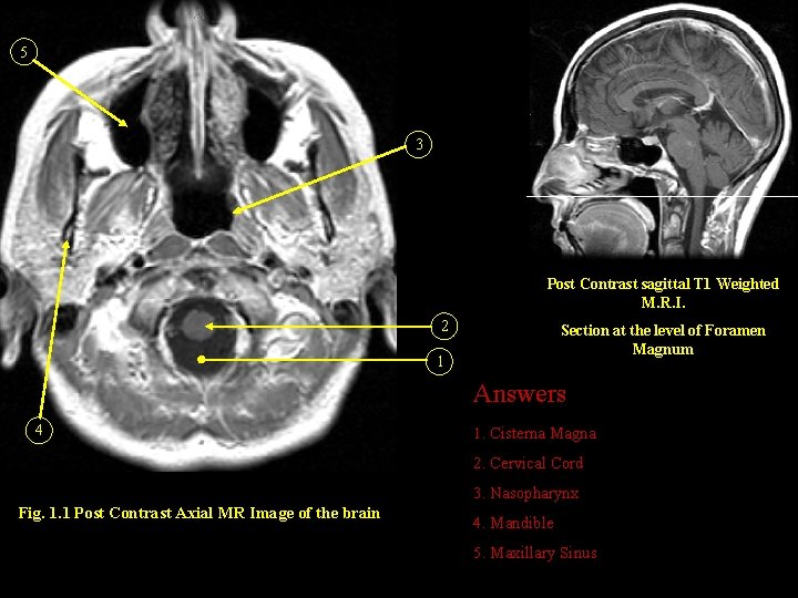 5 3 Post Contrast sagittal T 1 Weighted M. R. I. 2 Section at