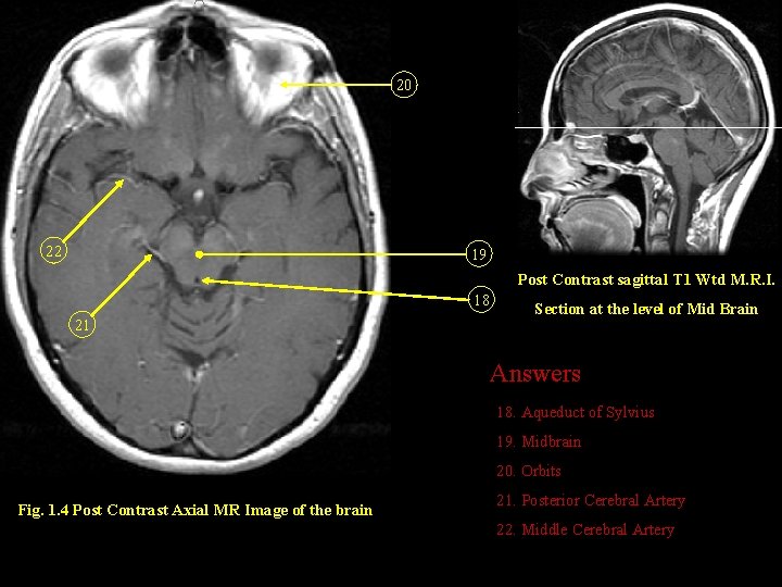 20 22 19 Post Contrast sagittal T 1 Wtd M. R. I. 18 21