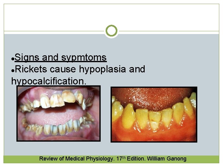 Signs and sypmtoms l. Rickets cause hypoplasia and hypocalcification. l Review of Medical Physiology. Signs and sypmtoms l. Rickets cause hypoplasia and hypocalcification. l Review of Medical Physiology.