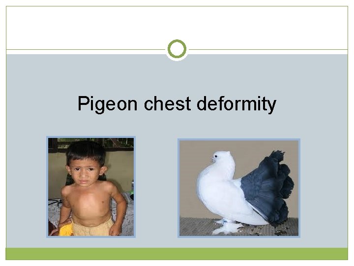 Pigeon chest deformity  Pigeon chest deformity