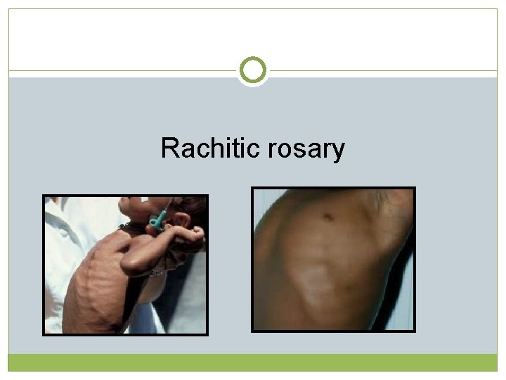 Rachitic rosary  Rachitic rosary