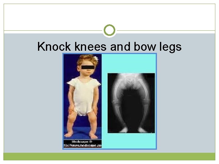 Knock knees and bow legs  Knock knees and bow legs
