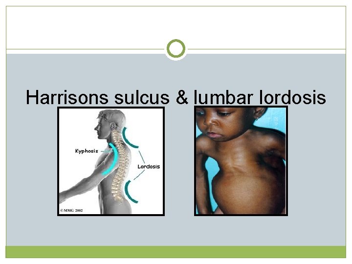 Harrisons sulcus & lumbar lordosis  Harrisons sulcus & lumbar lordosis