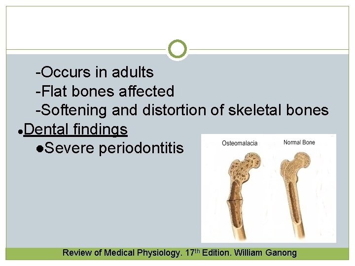 -Occurs in adults -Flat bones affected -Softening and distortion of skeletal bones l. Dental -Occurs in adults -Flat bones affected -Softening and distortion of skeletal bones l. Dental