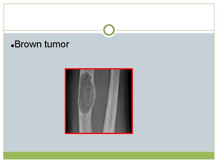 l Brown tumor  l Brown tumor