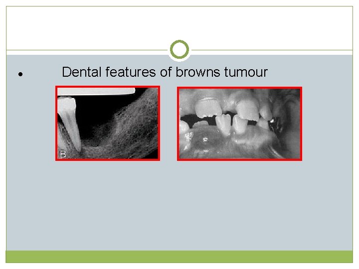 Dental features of browns tumour l   Dental features of browns tumour l
