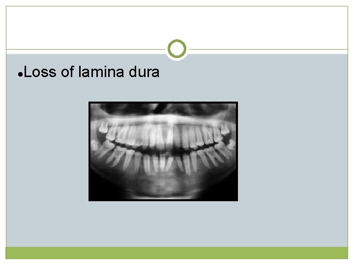 l Loss of lamina dura  l Loss of lamina dura