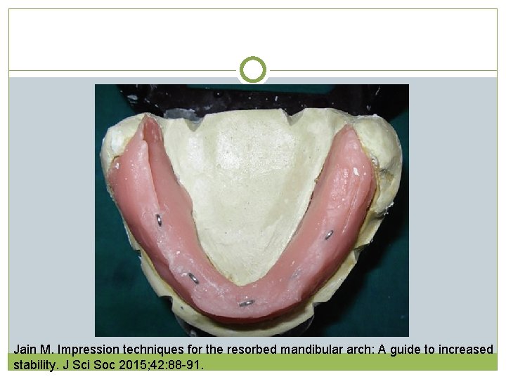 Jain M. Impression techniques for the resorbed mandibular arch: A guide to increased stability. Jain M. Impression techniques for the resorbed mandibular arch: A guide to increased stability.