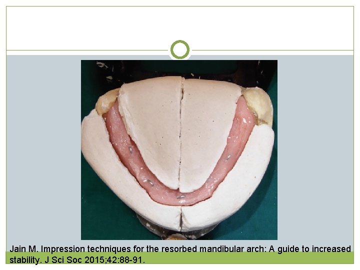 Jain M. Impression techniques for the resorbed mandibular arch: A guide to increased stability. Jain M. Impression techniques for the resorbed mandibular arch: A guide to increased stability.