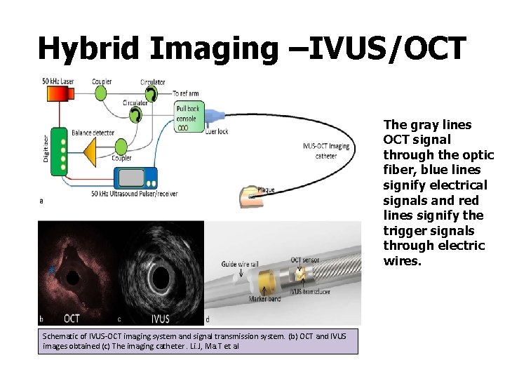 Hybrid Imaging –IVUS/OCT The gray lines OCT signal through the optic fiber, blue lines