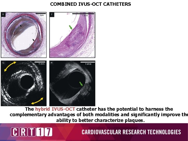 COMBINED IVUS-OCT CATHETERS The hybrid IVUS-OCT catheter has the potential to harness the complementary