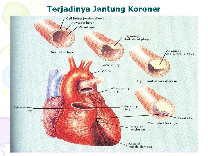 Terjadinya Jantung Koroner 