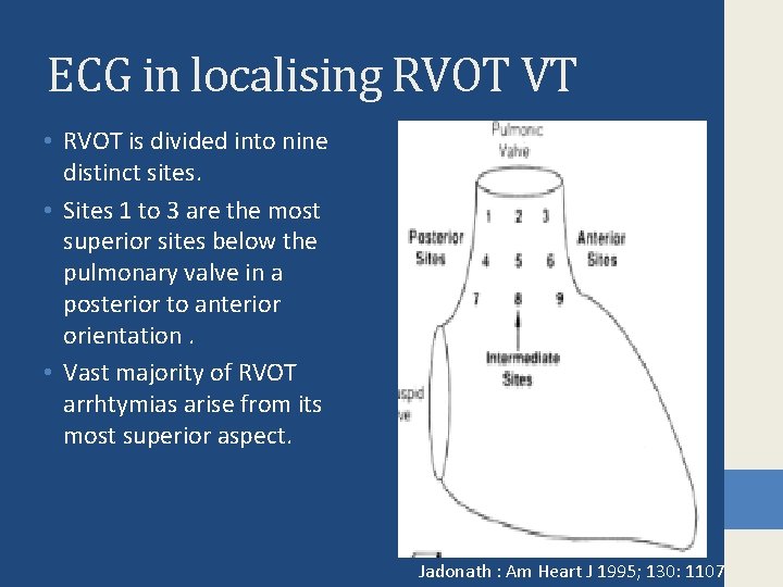 ECG in localising RVOT VT • RVOT is divided into nine distinct sites. •