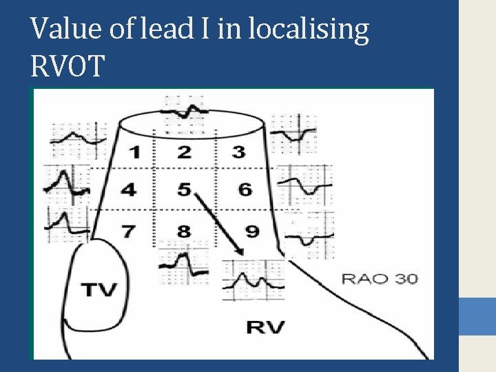 Value of lead I in localising RVOT 