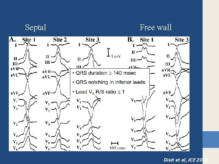 Septal Free wall Dixit et al, JCE 2003 