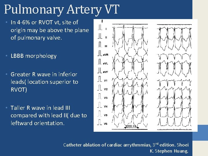 Pulmonary Artery VT • In 4 -6% or RVOT vt, site of origin may