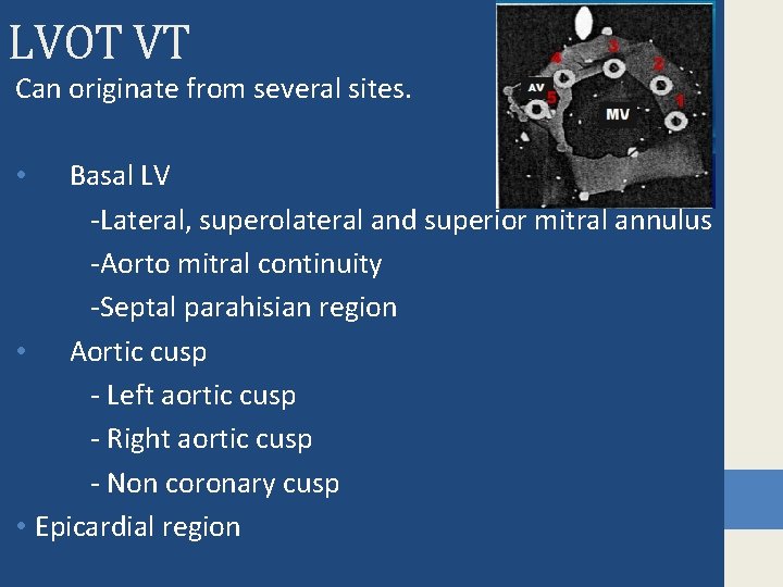 LVOT VT Can originate from several sites. Basal LV -Lateral, superolateral and superior mitral