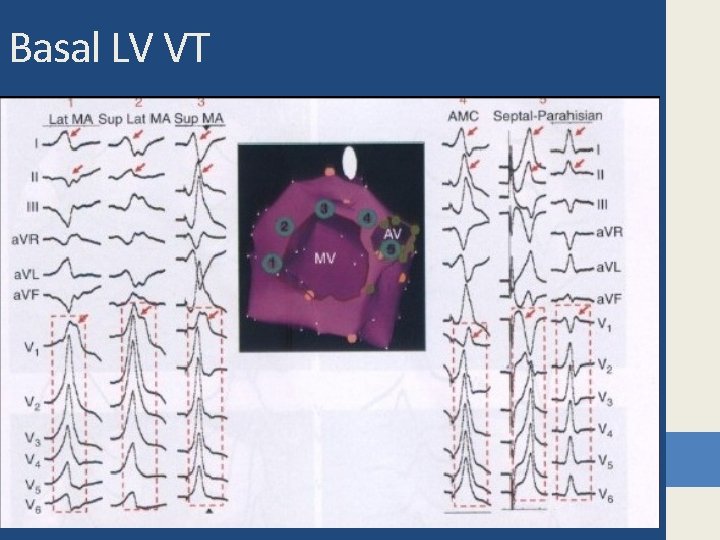 Basal LV VT 