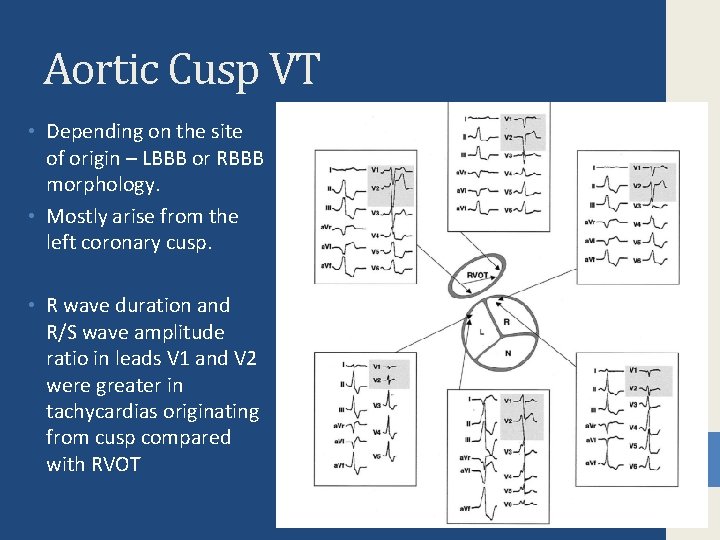 Aortic Cusp VT • Depending on the site of origin – LBBB or RBBB