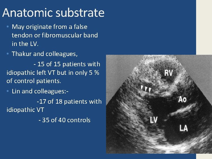 Anatomic substrate • May originate from a false tendon or fibromuscular band in the
