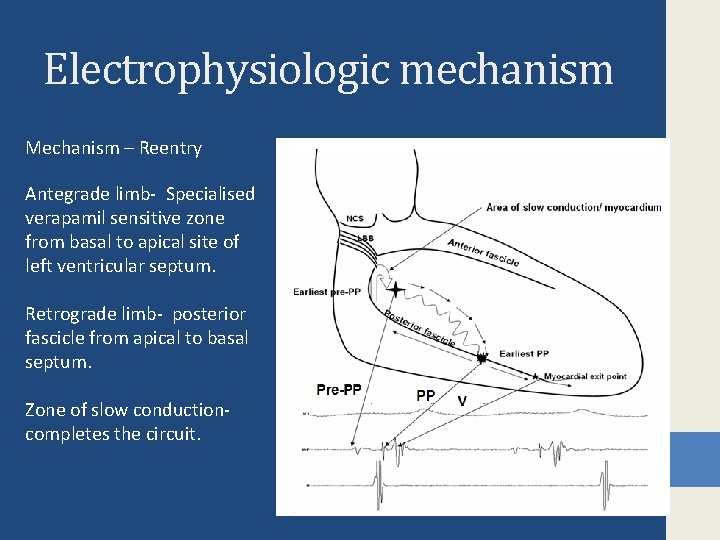 Electrophysiologic mechanism Mechanism – Reentry Antegrade limb- Specialised verapamil sensitive zone from basal to