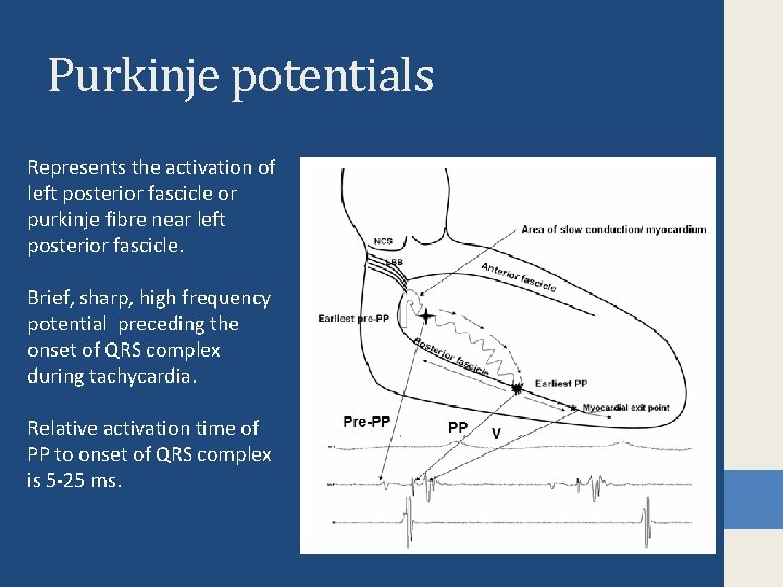 Purkinje potentials Represents the activation of left posterior fascicle or purkinje fibre near left