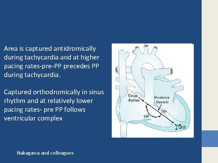 Area is captured antidromically during tachycardia and at higher pacing rates-pre-PP precedes PP during