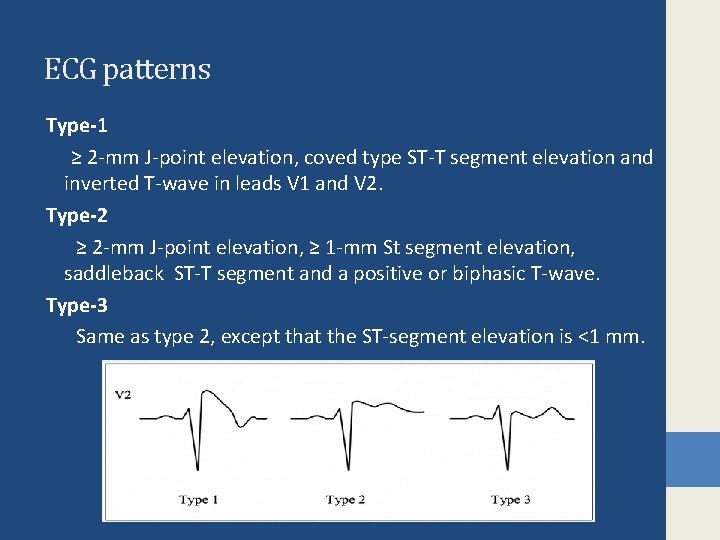 ECG patterns Type-1 ≥ 2 -mm J-point elevation, coved type ST-T segment elevation and