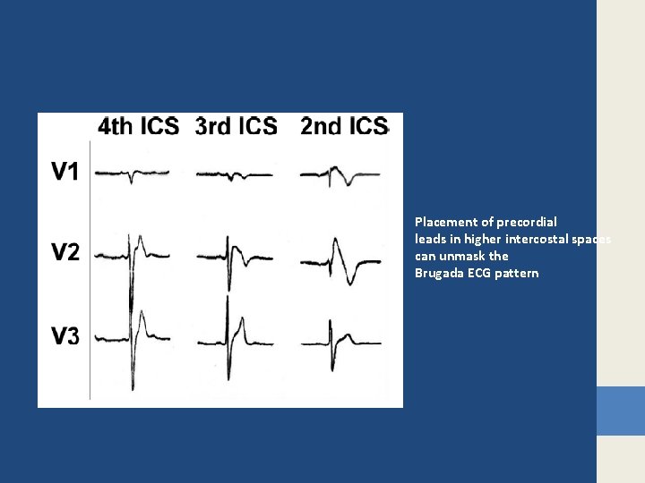 Placement of precordial leads in higher intercostal spaces can unmask the Brugada ECG pattern