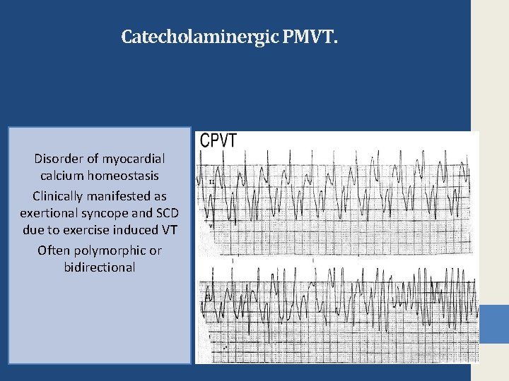 Catecholaminergic PMVT. Disorder of myocardial calcium homeostasis Clinically manifested as exertional syncope and SCD